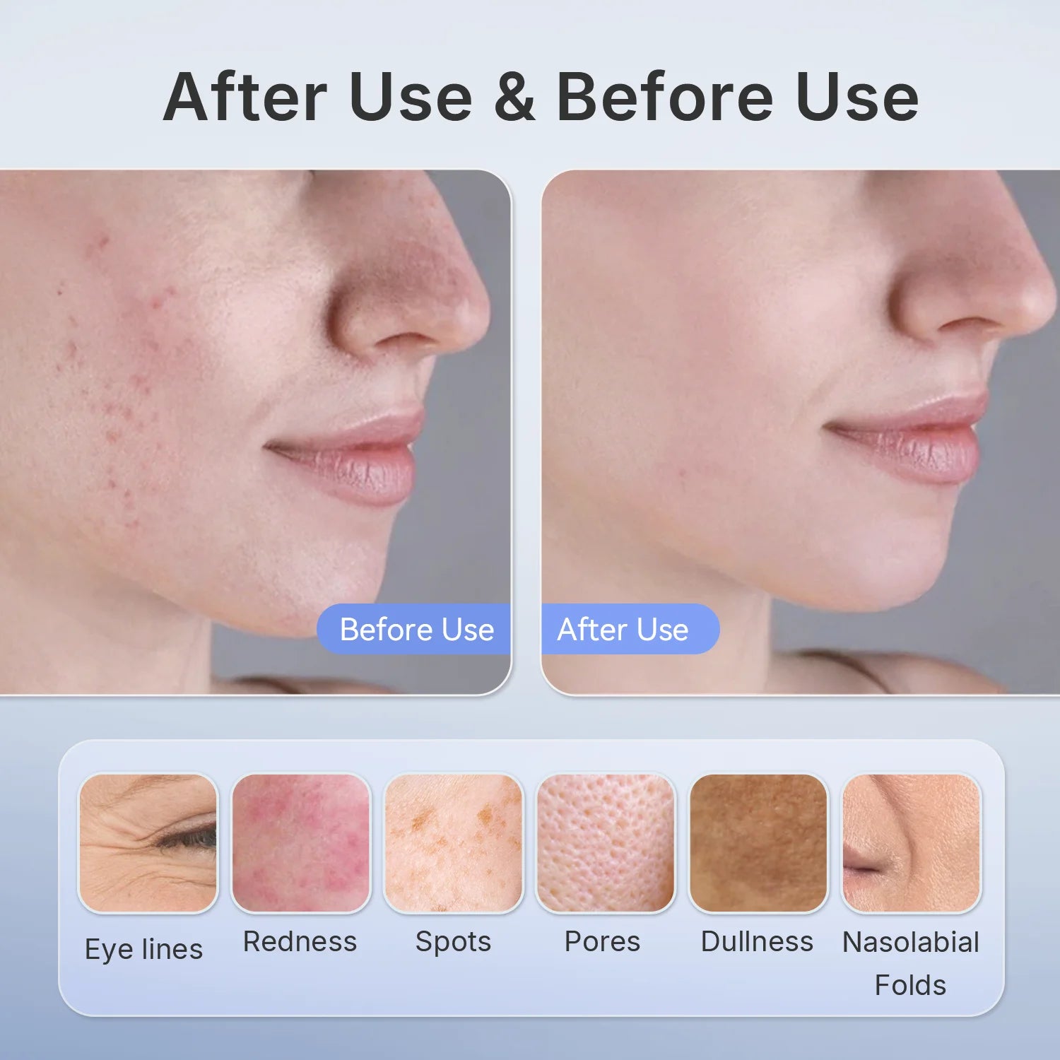 Before and after use comparison of skin treatment on a person's face with labeled skin issues.